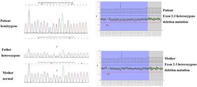 Case Report: White Colored Stool: An Early Sign of Cystic Fibrosis in Infants